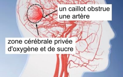 Un podcast sur l’AVC